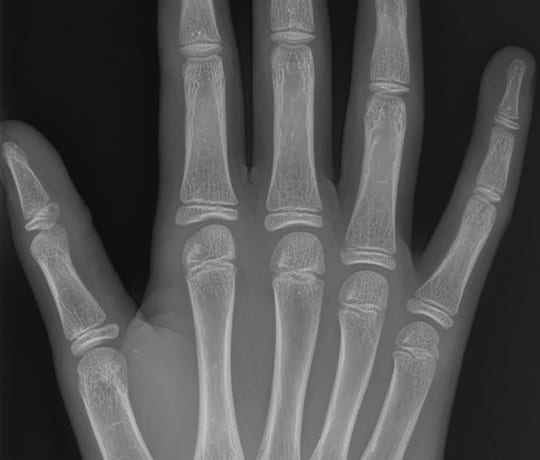 AZboneage pediatric hand X-ray analysis example