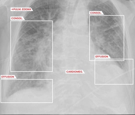 AZchest chest X-ray findings example