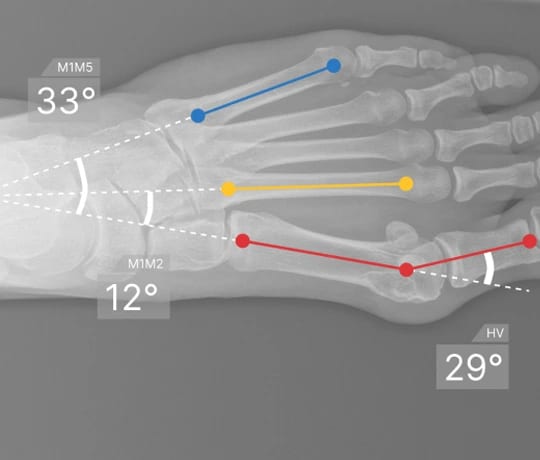 AZmeasure automated X-ray measurement example