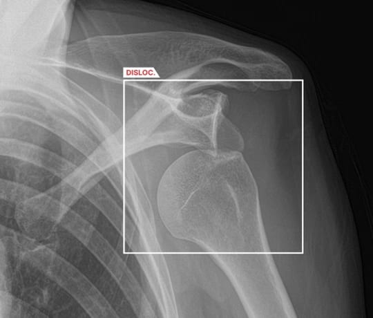 AZtrauma fracture detection example