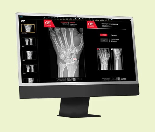Rayvolve AI software displayed on a radiology workstation