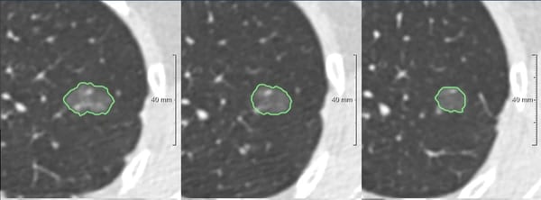 Veolity LungCAD pulmonary nodule analysis