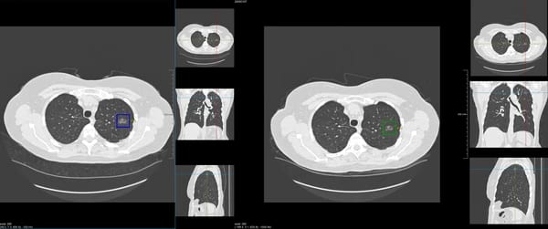 Veolity LungRead interface showing current and prior chest CT studies